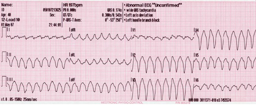 Difference Between Ventricular Tachycardia Vtach And Ventricular Fibrillation Vfib Difference Between