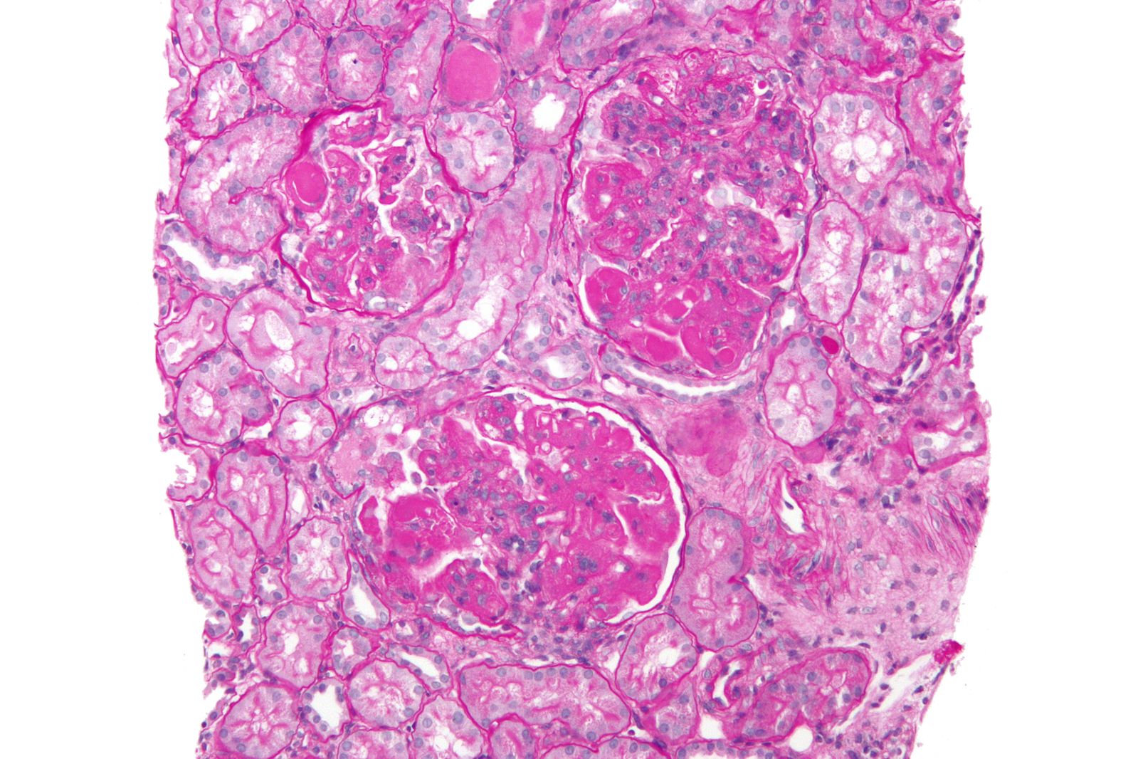 difference-between-hashimoto-s-and-lupus-difference-between