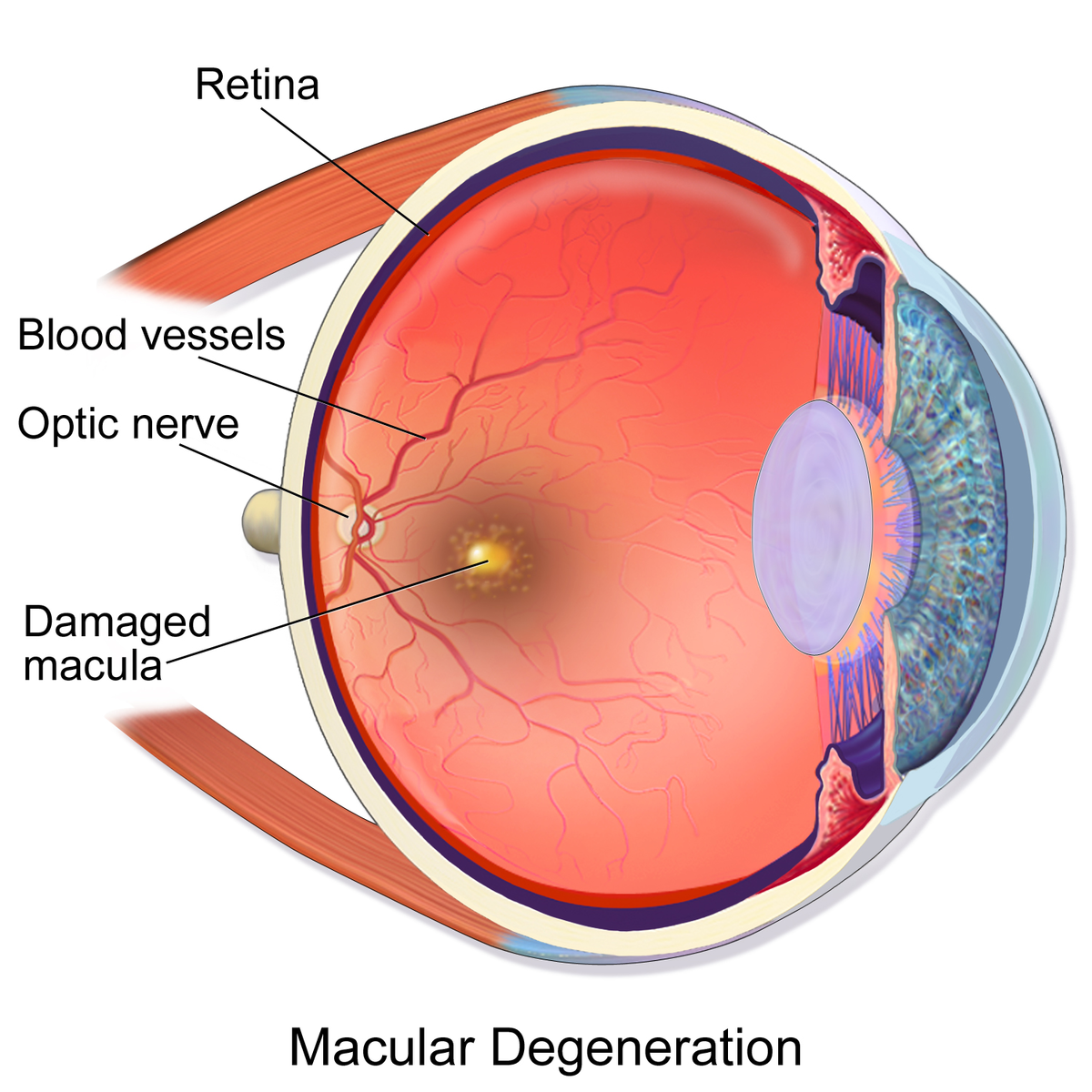 Difference Between Diabetic Retinopathy and Macular Degeneration