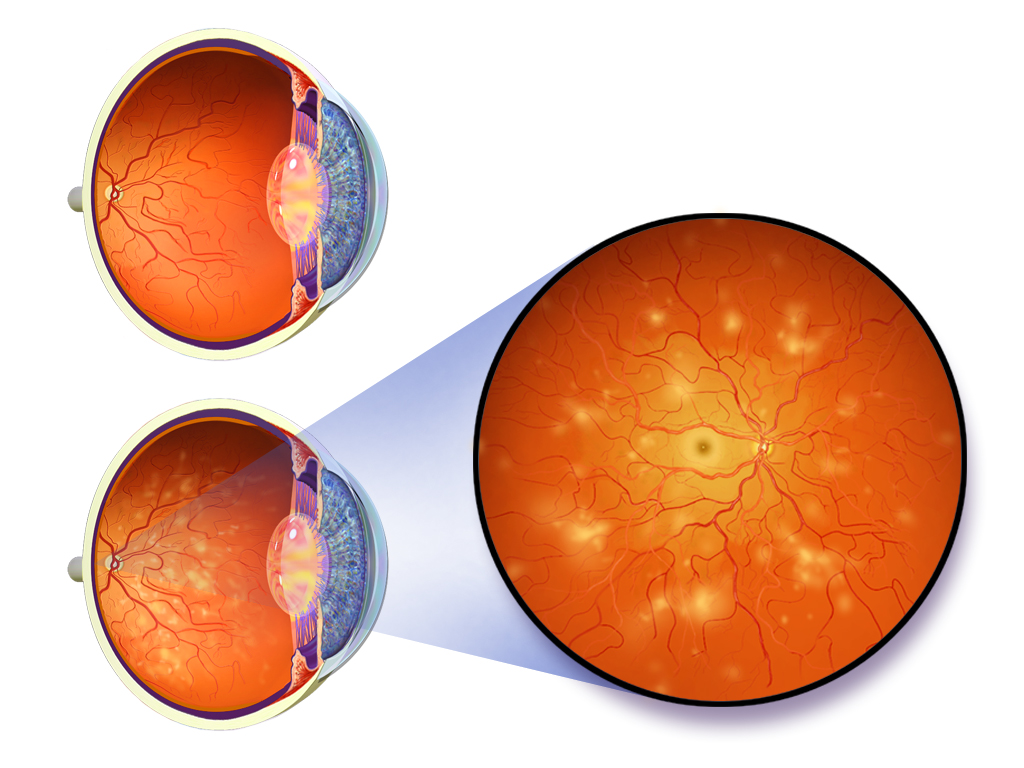 can-diabetic-retinopathy-be-reversed-sahyadri-hospitals