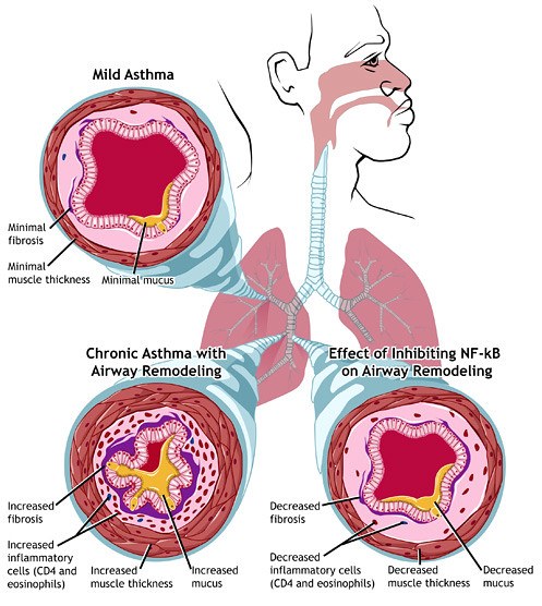 adventitious breath sounds asthma