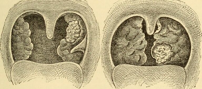 Difference Between Menieres Disease And Labyrinthitis Difference Between