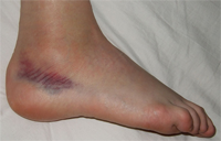 sprain