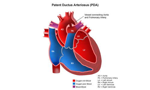 PFO & PDA