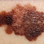 Take care of your skin! What you need to know about skin cancer (carcinomas and melanomas)