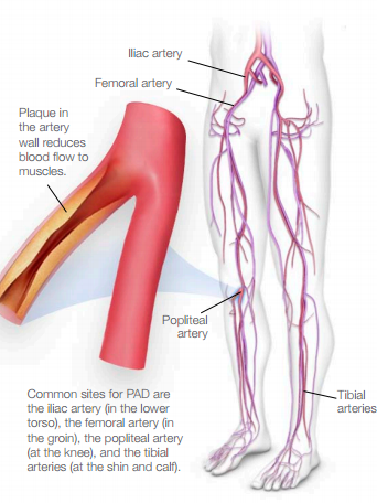 unraveling the interpretations of Peripheral vascular disease (PVD) and Peripheral arterial disease (PAD)