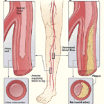 Undefined concepts unraveling the interpretations of Peripheral vascular disease (PVD) and Peripheral arterial disease (PAD)-2