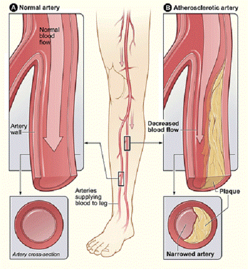 Undefined concepts unraveling the interpretations of Peripheral vascular disease (PVD) and Peripheral arterial disease (PAD)-2