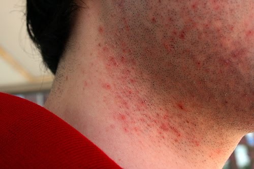 Difference between razor burn and herpes