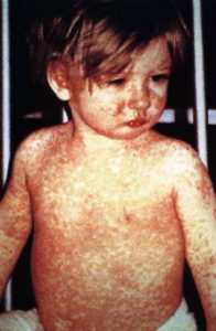 Difference between Measles and Rubella