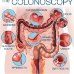 Difference between Sigmoidoscopy and Colonoscopy-1