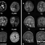 Difference Between Meningitis and Encephalitis