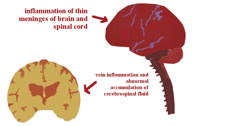 Difference Between Meningitis and Encephalitis