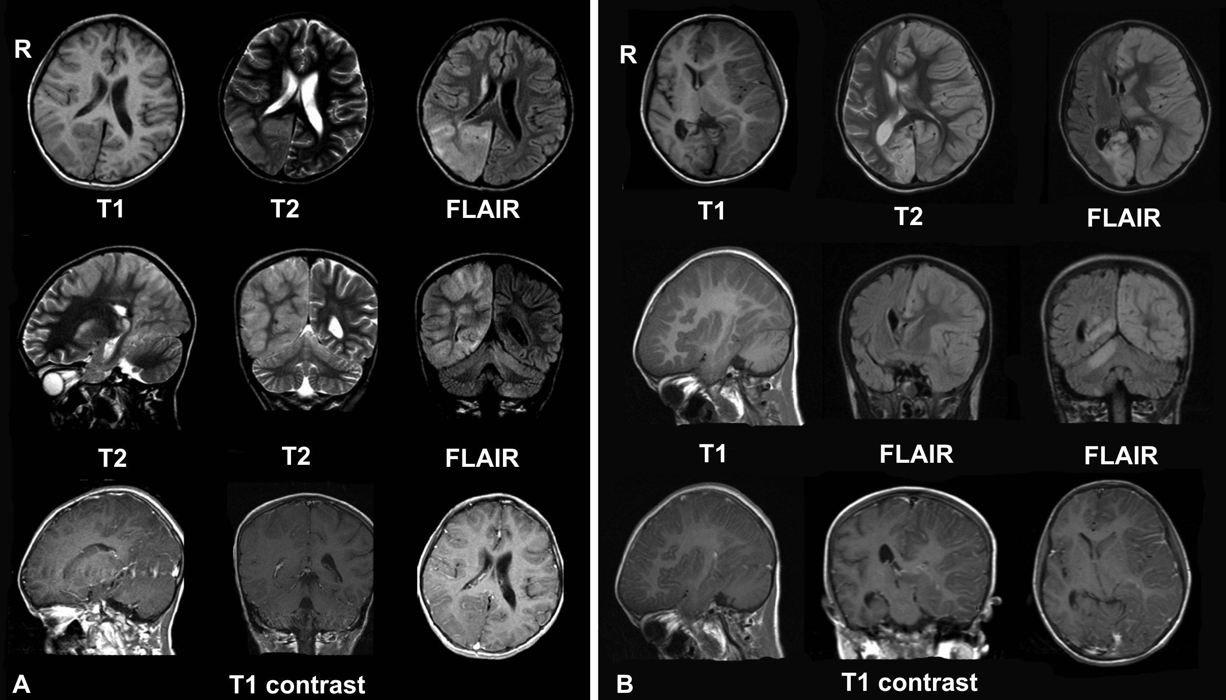 Difference Between Meningitis and Encephalitis