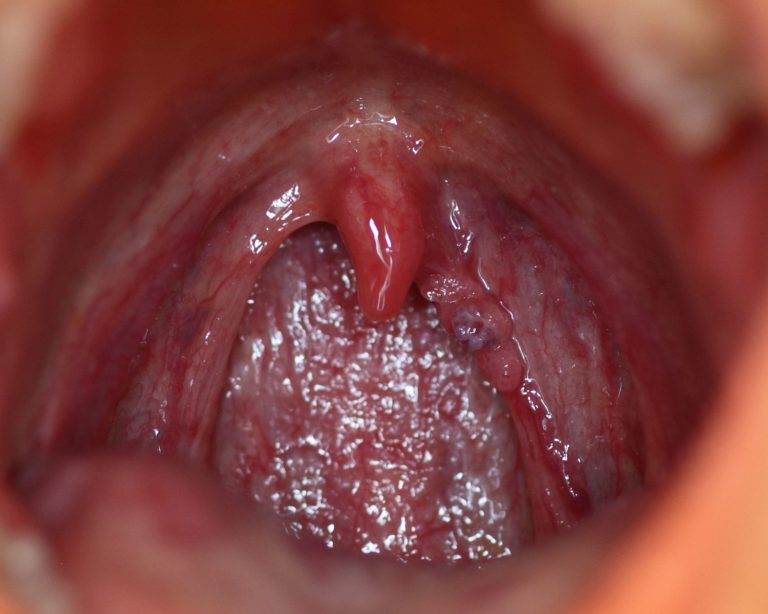 Difference Between Chlamydia And Hpv Difference Between Chlamydia