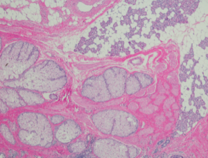 Difference Between Hamartoma and Teratoma | Difference Between ...